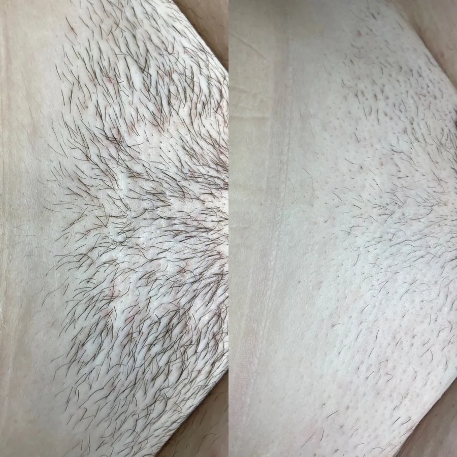 PCOS electrolysis specialist Irvine CA