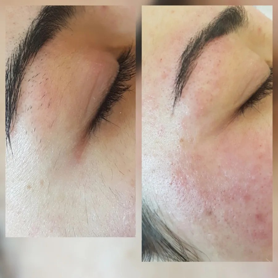 Eyebrow and forehead area hair electrolysis removal before and after Irvine CA