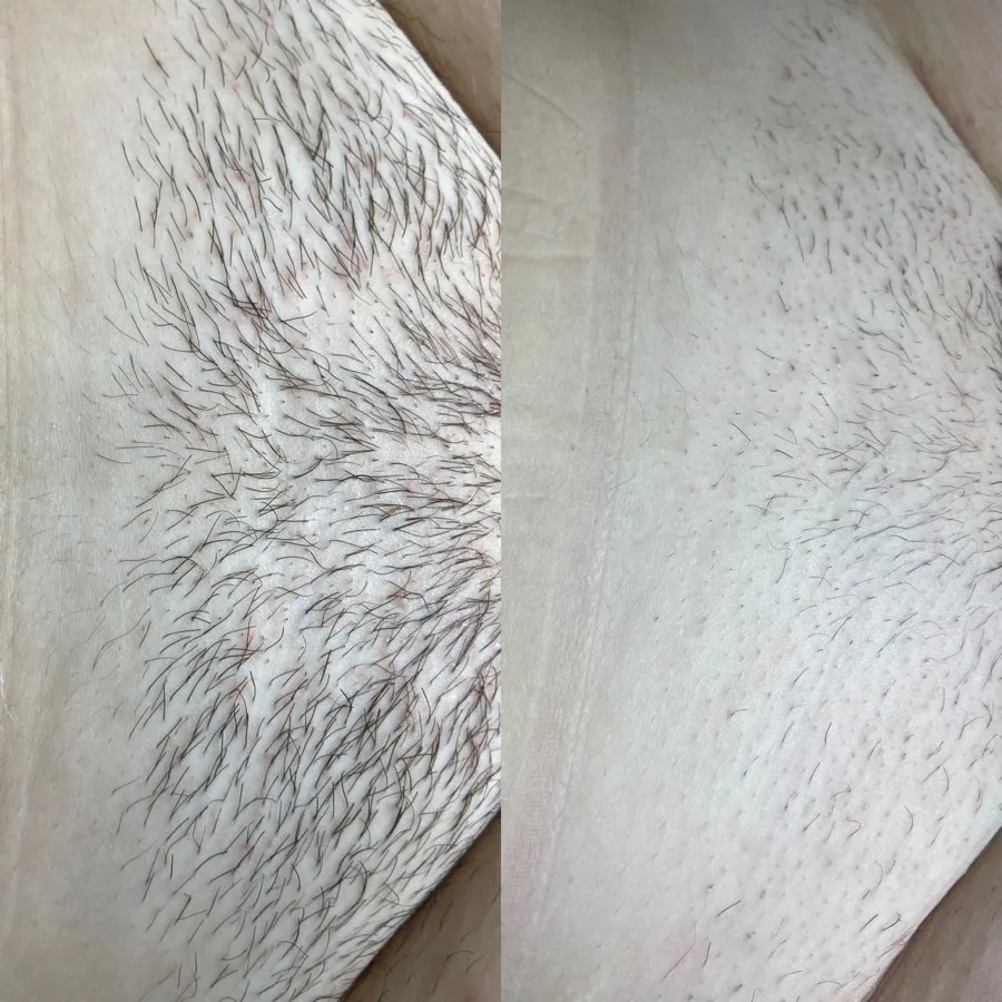 Electrolysis and skin care near Lake Forest CA - Real Skin Beauty Irvine