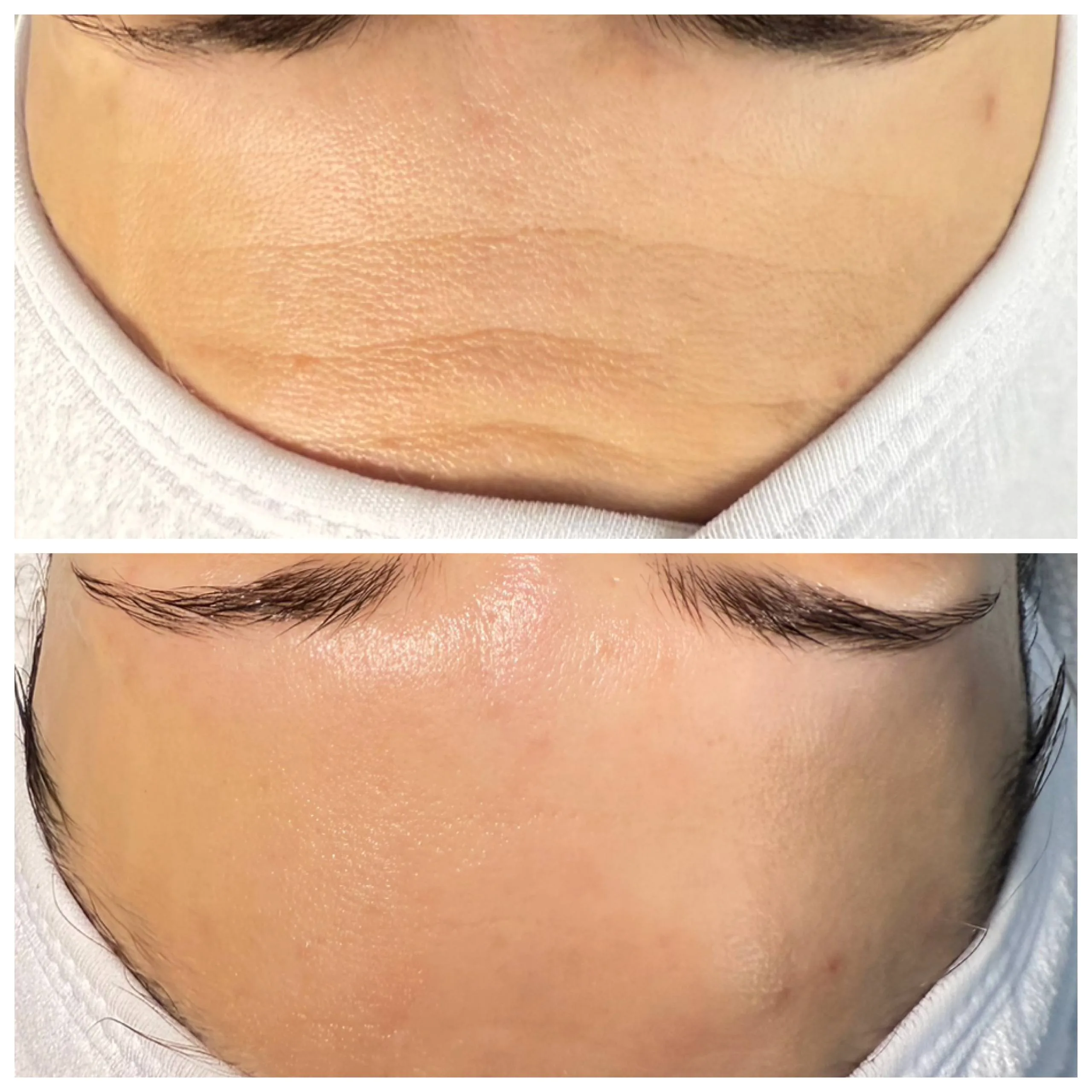 Electroporation complex facial treatment before and after Irvine CA