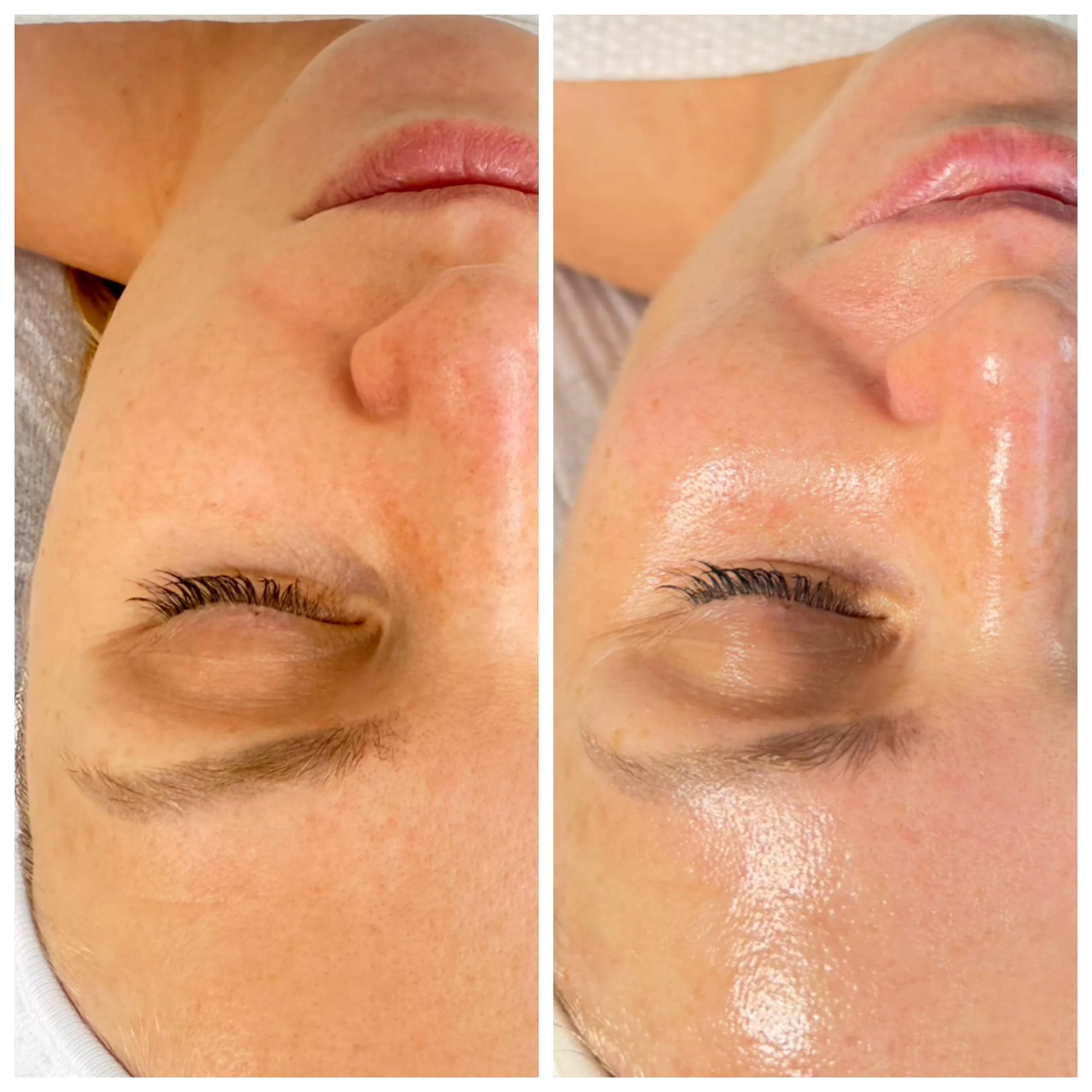 Chemical peel Laguna Beach
