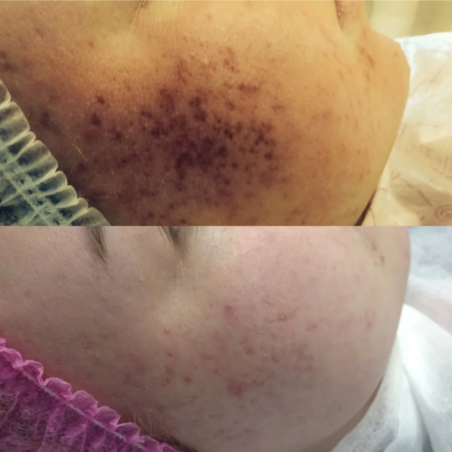 Hyperpigmentation body dark spot treatment before and after Irvine CA